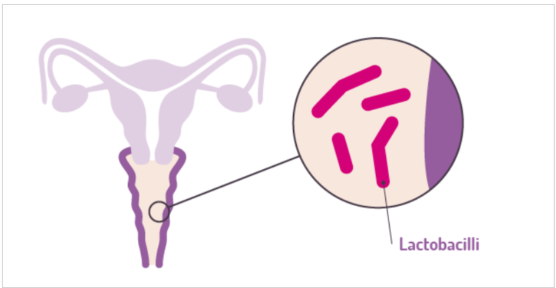 Understanding Bacterial Vaginosis: Causes, Symptoms & Treatment